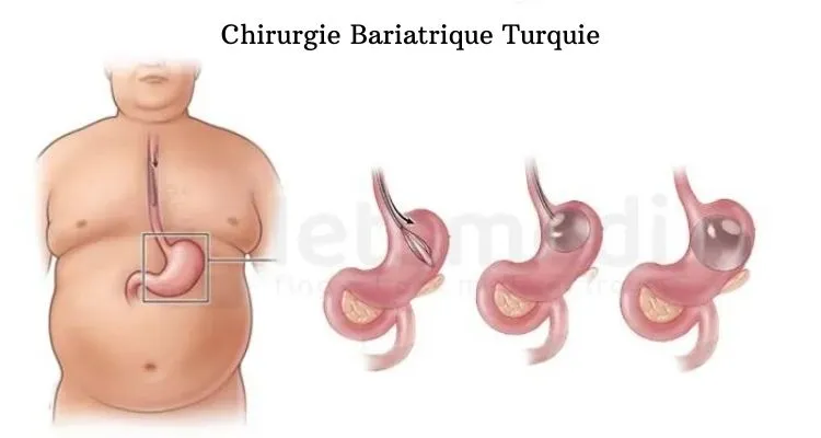 Chirurgie-Bariatrique-Turquie