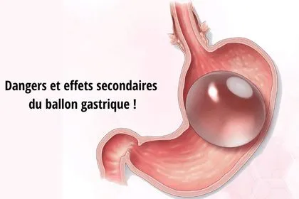 Dangers et effets secondaires du ballon gastrique