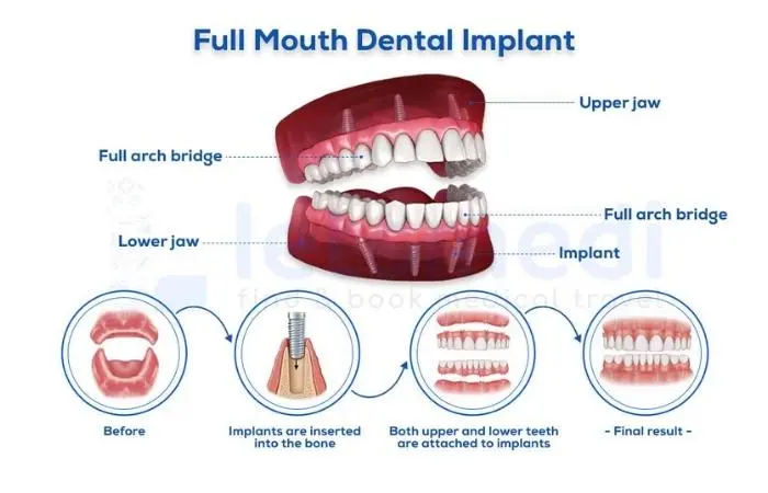 Les étapes de la pose d'implants dentaires en Turquie