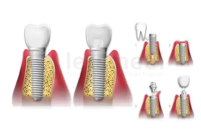 Prix des marques d'implants dentaires en Turquie